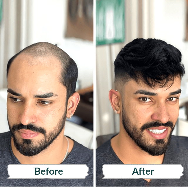Hair Fixing Cost in Qatar – Affordable Solutions at Hair Revive