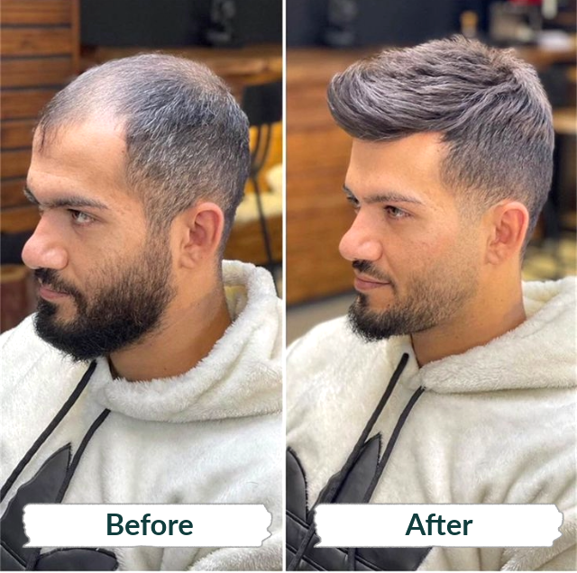 Hair Fixing Cost in Qatar – Affordable Solutions at Hair Revive