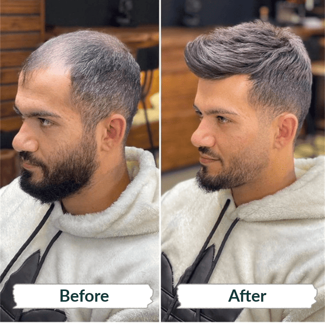 Male Hair Restoration in Qatar | Hair Replacement for Men